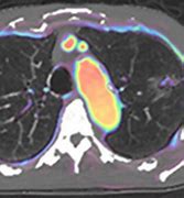 Image result for Lung Tumor Pet Scan
