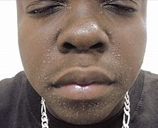 Image result for Allergy Rash On Black Person