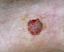 Image result for Skin Cancer Leg