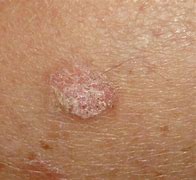 Image result for Keratosis Types