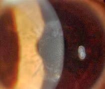 Image result for Lasik Corneal Scar