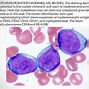 Image result for Adult Acute Myeloid Leukemia