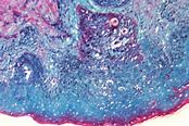Image result for Molluscum Contagiosum Lesions