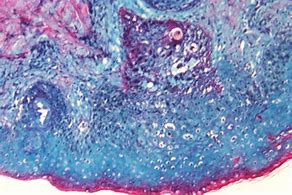 Image result for Pox Virus Molluscum