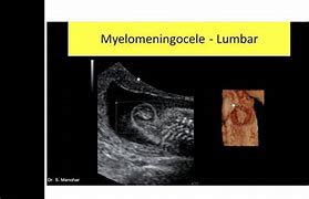 Image result for Myelomeningocele