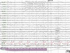 Image result for Wicket Spikes EEG