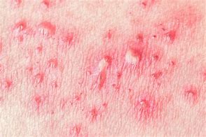 Image result for Chickenpox Shingles