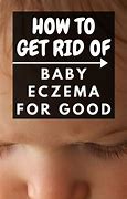 Image result for Eczema Treatment in a 5 Month Old Baby
