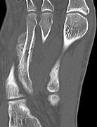 Image result for March Fracture