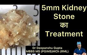 Image result for 5 mm Kidney Stone