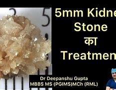 Image result for Picture of 5Mm Kidney Stone