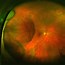 Image result for Retina Cyst