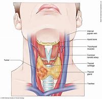 Image result for Staging of Papillary Thyroid Cancer TNM
