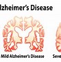 Image result for Dementia Shrinking Brain