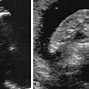 Image result for Carotid Artery in Neck