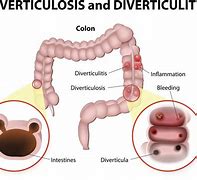 Image result for diverticular causes