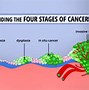 Image result for Kidney Cancer Staging