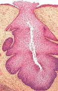 Image result for Inverted Papilloma Nose