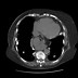 Image result for Calcified Lung Nodules Radiology