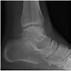 Image result for Styloid Process Foot