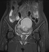 Image result for Ovarian Cyst Torsion