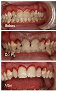 Image result for Tooth Decay Before and After