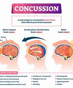 Image result for Concussion Fingers