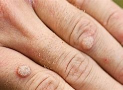 Image result for Wart to Back of Leg Cryotherapy