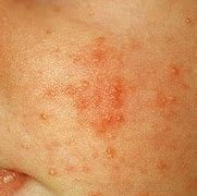 Image result for Bumps On Skin That Look Like Pimples