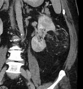 Image result for Kidney Tumor Size