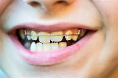 apparecchio mobile come si raddrizzano i denti roberto perasso apparecchio mobile come si raddrizzano i denti roberto perasso
