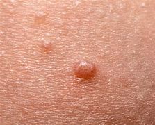 Image result for Silver Cure for Molluscum