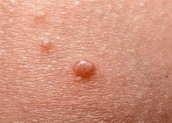 Image result for Musculum Warts