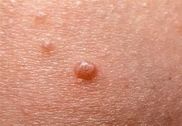 Image result for Molluscum Treatment Before and After