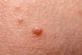 Image result for Molluscum Warts Treatment