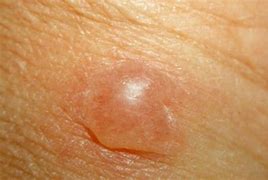 Image result for Leg Bumps Under Skin