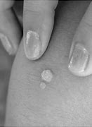 Image result for Common Warts On Face