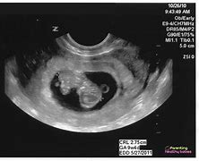 Image result for 9 Week OB Ultrasound