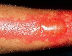 Image result for 2nd Degree Leg Burn