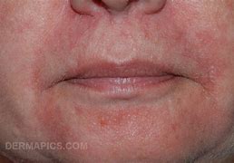 Image result for Rash around Mouth and Chin