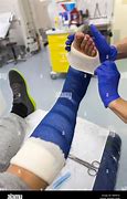 Image result for Broken Leg Plaster Cast