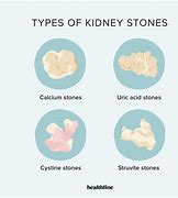 Image result for 3Mm Kidney Stone