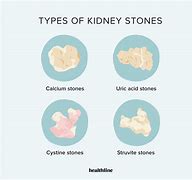 Image result for 15 mm Kidney Stone