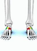 Image result for 4th Metatarsal Fracture