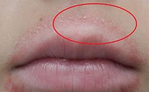 Image result for Allergic Reaction On Lips From Food
