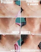 Image result for Wart Removal Before and After