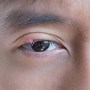 Image result for Molluscum Contagiosum On Eyelid