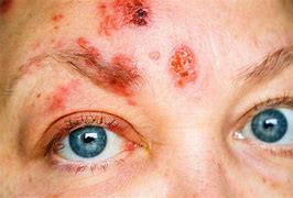 Image result for Herpes Zoster