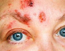 Image result for Zoster Rash