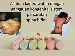 Image result for Spina Bifida Adalah